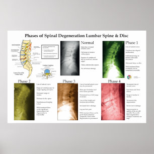 Poster Degeneração Espinhal Coluna Lombar Quiropraxia