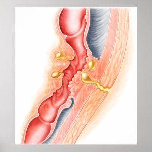 Pôster Desenvolvimento De Fístula