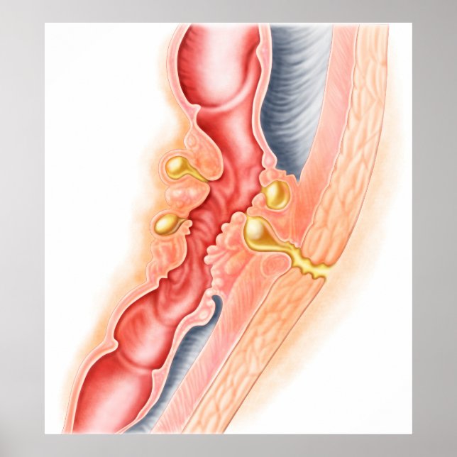 Pôster Desenvolvimento De Fístula (Frente)