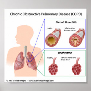 Pôster diagrama de doenças pulmonares da COPD