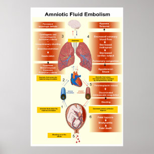 Poster Diagrama de um Embolismo de Fluido Amniótico AFE