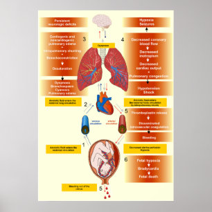 Poster Diagrama de um embolismo do líquido Amniotic