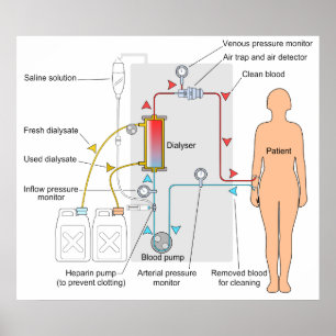 Poster Diagrama de um tratamento médico da hemodiálise