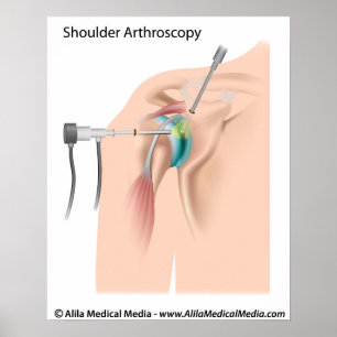 Poster Diagrama do arthroscopy do ombro