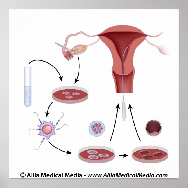 Pôster Diagrama sem rótulo do procedimento IVF. (Frente)