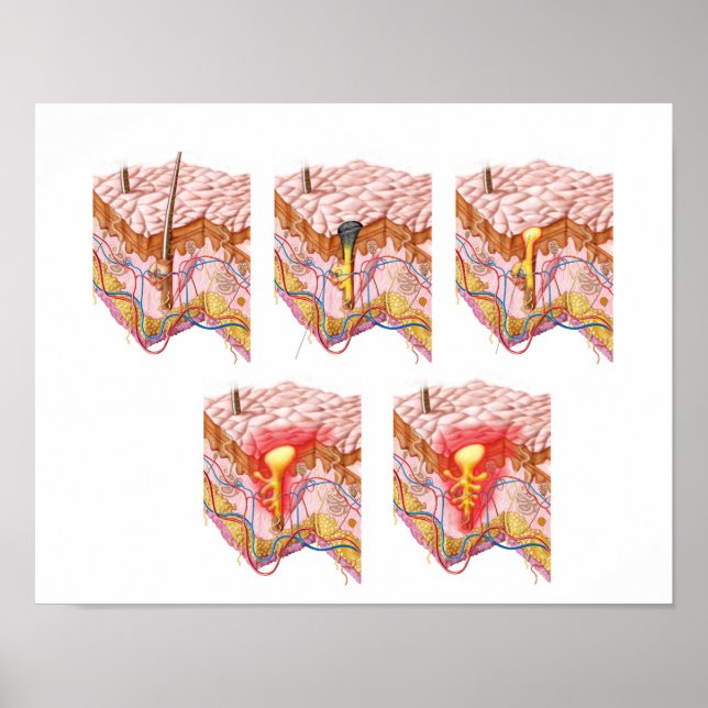 Pôster Diferentes Tipos De Acne (Frente)