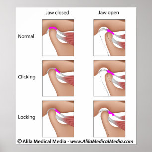 Pôster Disfunção das articulações temporomandibulares, TM