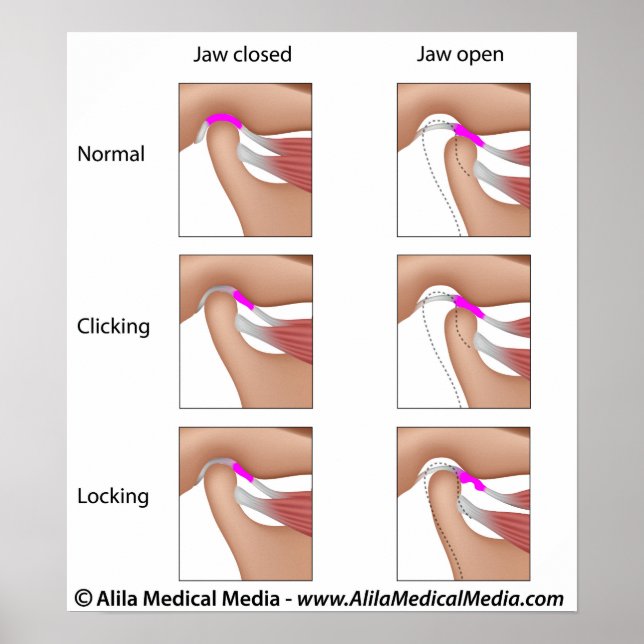 Pôster Disfunção das articulações temporomandibulares, TM (Frente)