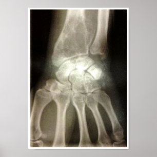 Poster do raio X dos Carpals