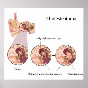 Poster do tumor da orelha média de Cholesteatoma
