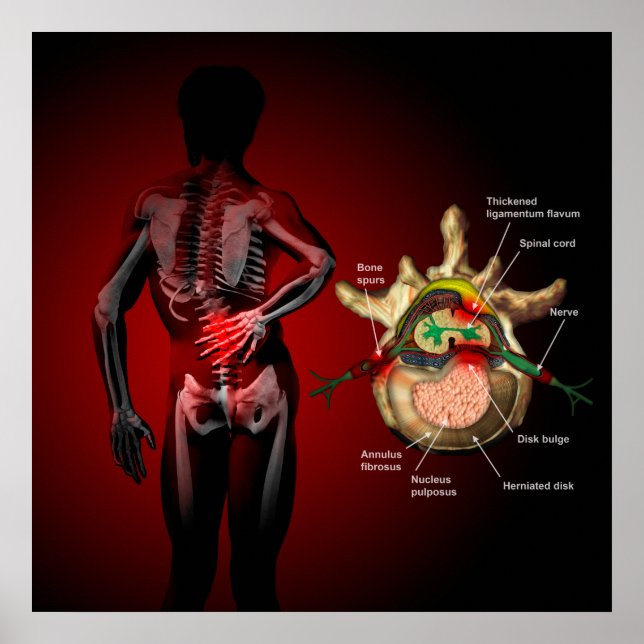 Poster Dor lombar (Frente)