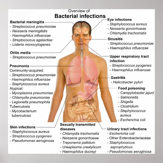 Poster Gráfico das principais infecções bacterianas no se (Frente)