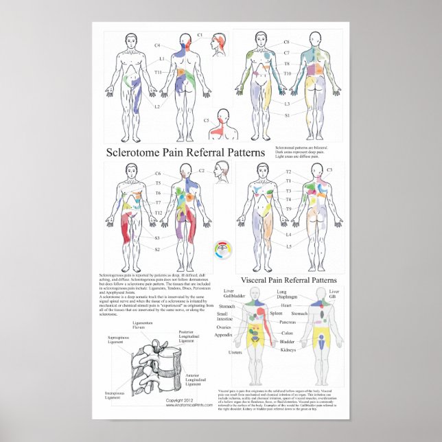 Pôster Gráfico de Referência da Dor Visceral Esclerotomia (Frente)