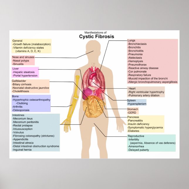 Poster Gráfico Detalhado dos Sintomas da Fibrose Cística (Frente)