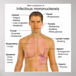 Pôster Gráfico dos principais sintomas da mononucleose in