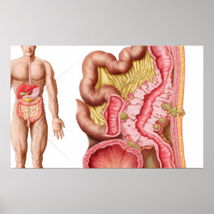 Poster Ilustração da diverticulose nos dois pontos