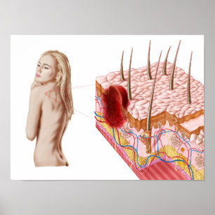 Poster Ilustração de um crescimento atípico na pele
