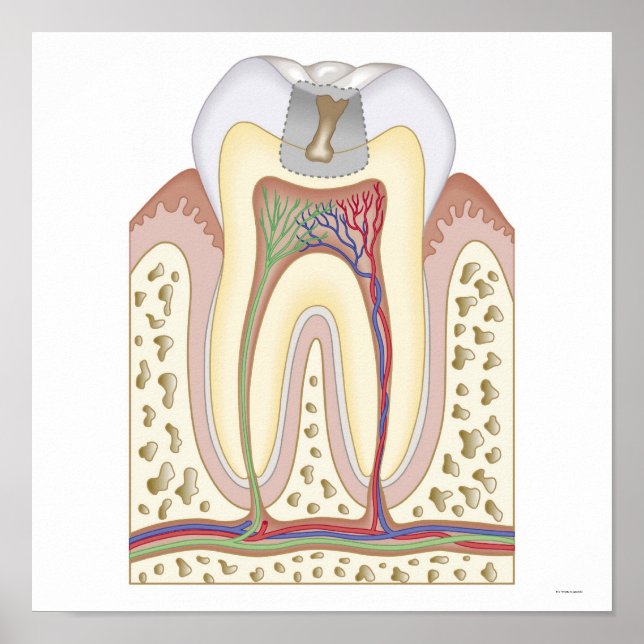 Pôster Ilustração do Decaimento dos Dentes (Frente)