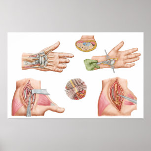 Poster Ilustração médica que mostra o túnel do Carpal