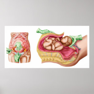 Pôster Ilustração que mostra a entrega Caesarean do fet