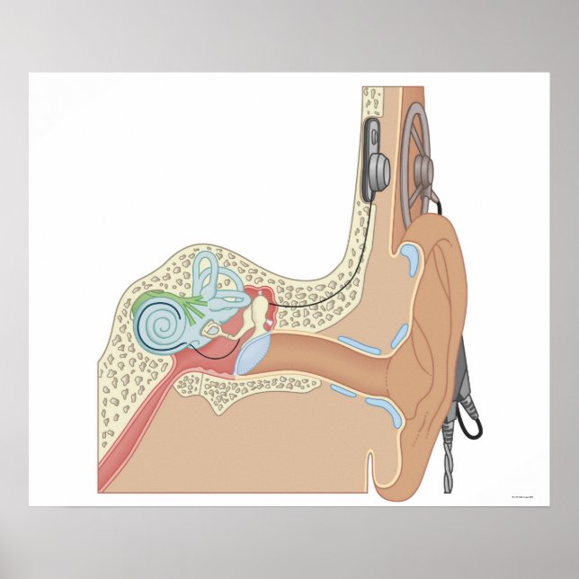 Pôster Implantes Cocleares (Frente)