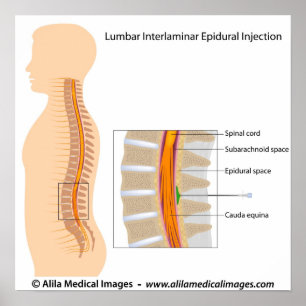 Pôster Injeção epidural lombar, diagrama marcado.