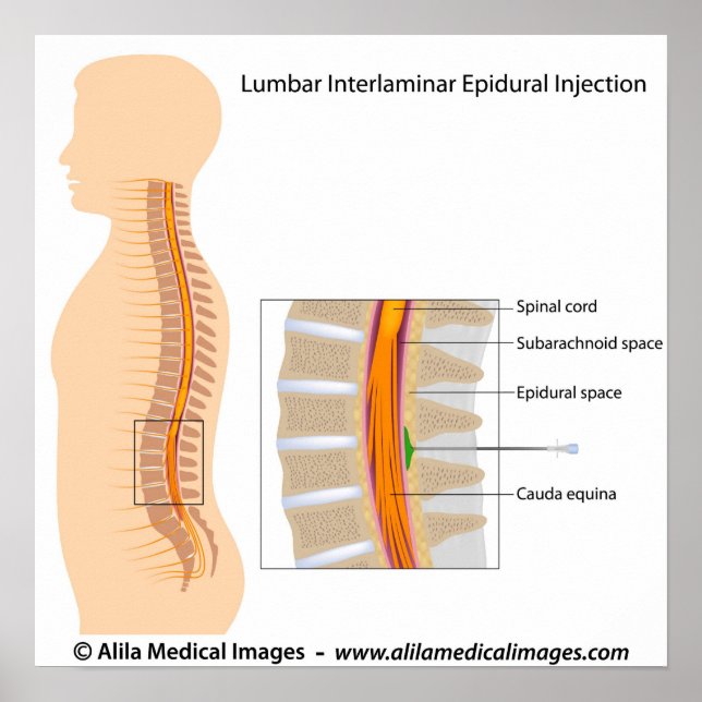 Pôster Injeção epidural lombar, diagrama marcado. (Frente)
