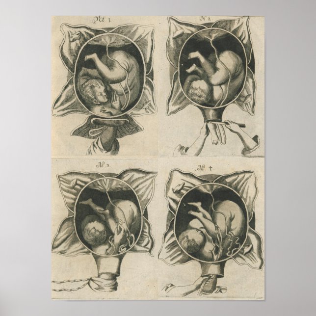 Poster Justine Siegemund Court Parteira Nascida Gravidez (Frente)