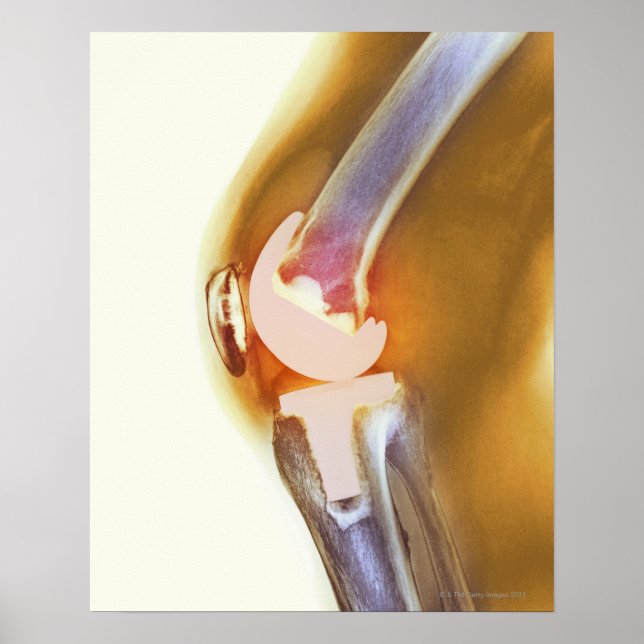 Pôster Knee replacement. Coloured X-ray of a total knee (Frente)