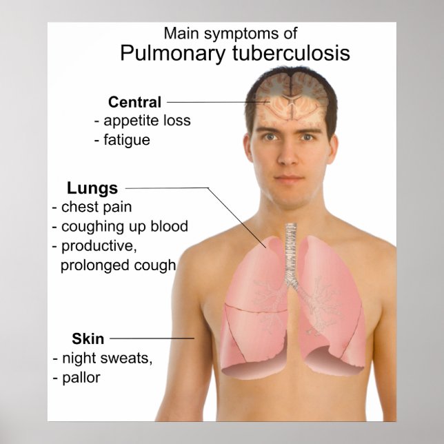 Poster Main Symptoms of Pulmonary Tuberculosis Chart (Frente)