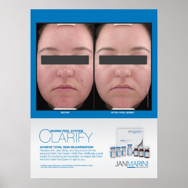 Pôster Marini Peel Clarify Resultados 18x24" (Frente)