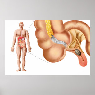 Pôster Medical Ilustration Of An Appendix