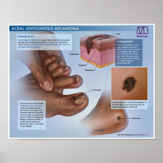 Poster Melalogic Acral Lentiginous Melanoma Medical Poste