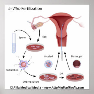 Poster Método de fertilização in vitro (FIV) rotulado.