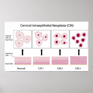 Pôster Palcos de displasia do colo do útero e teste de Pa