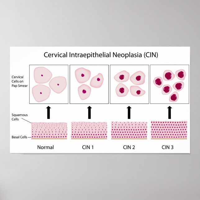 Pôster Palcos de displasia do colo do útero e teste de Pa (Frente)