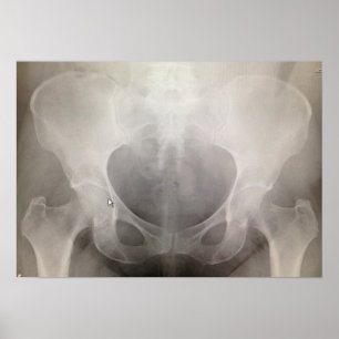 Pôster Pelvis X-ray