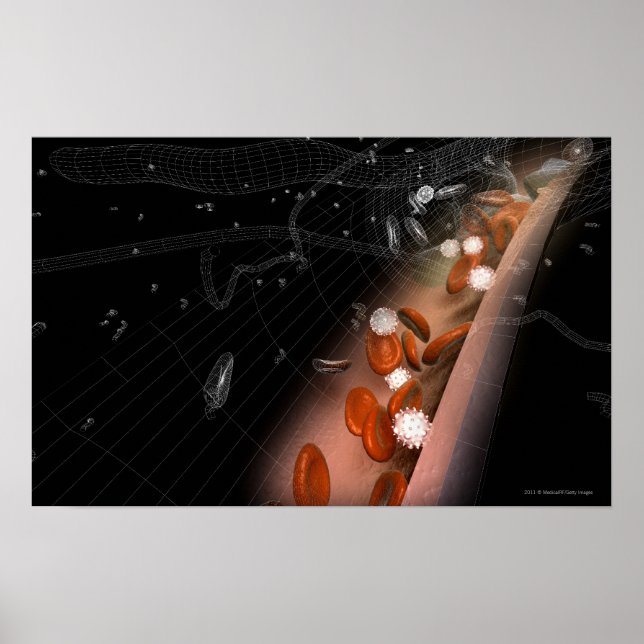 Pôster Placa nas artérias (Frente)