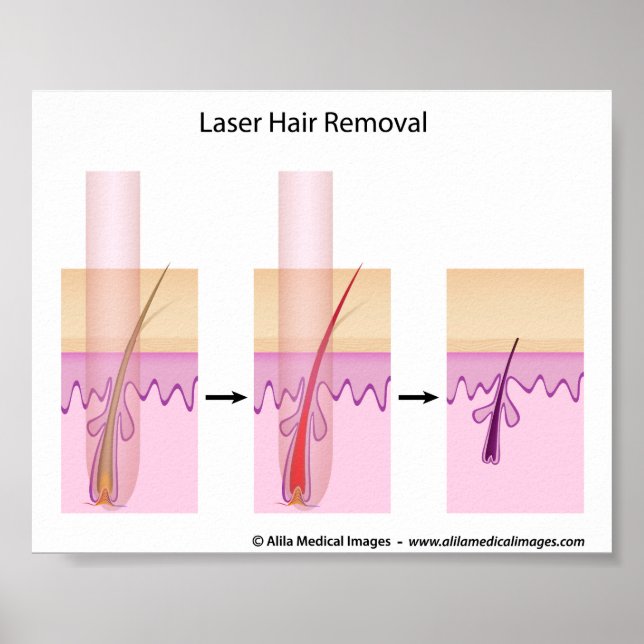 Pôster Procedimento de remoção de cabelo laser (Frente)