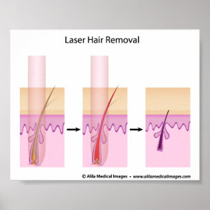 Pôster Procedimento de remoção do cabelo do laser