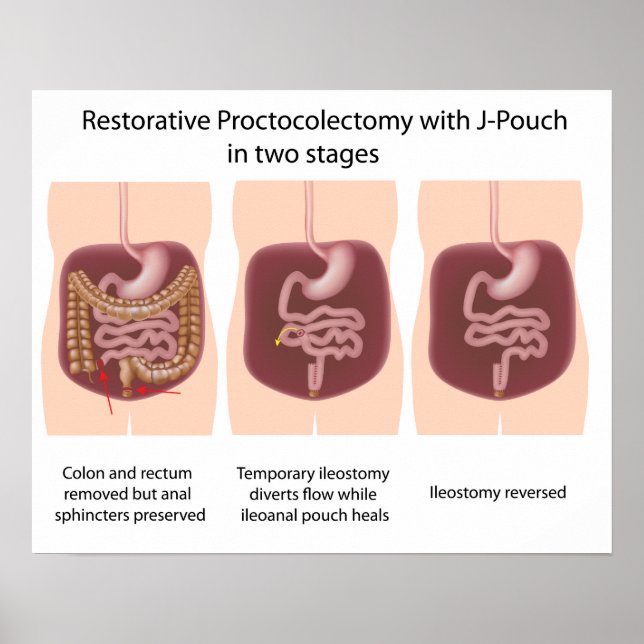 Pôster Proctocolectomia reativa com palcos j-pouch 2 (Frente)