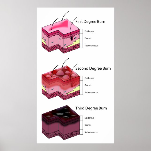 Poster Queimar Pele Primeiro e Terceiro Diagrama (Frente)