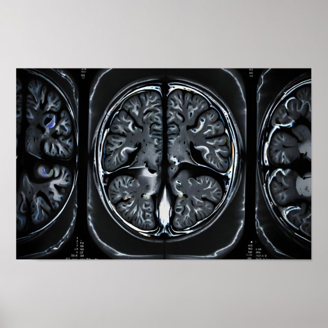 Poster ressonância magnética cerebral (Frente)