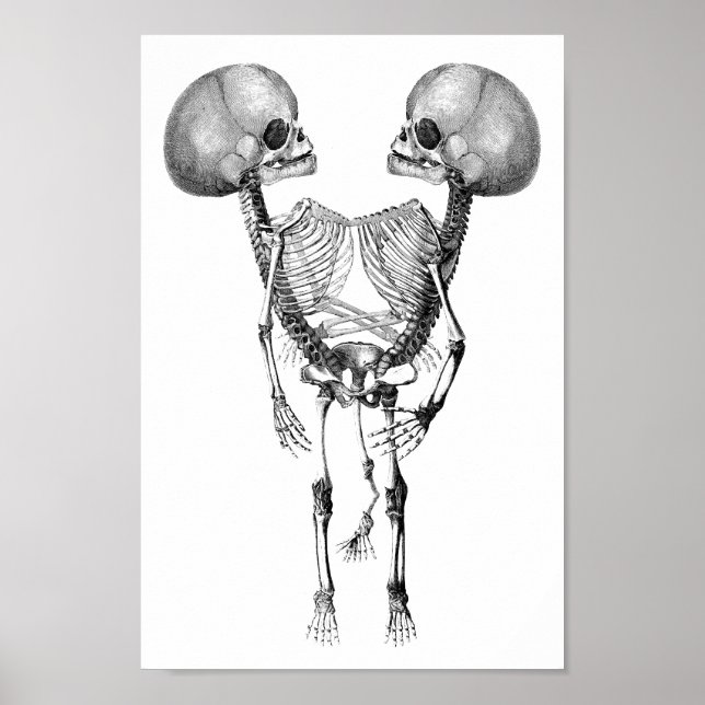 Poster Siamês juntou-se a Twins Anatomia Skeletons (Frente)