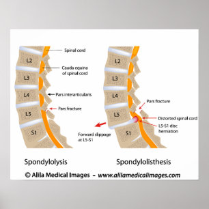 Poster Spondylolysis e spondylolisthesis, etiquetados