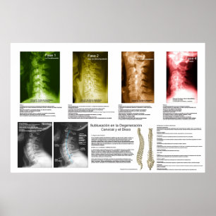 Poster Subluxação Espanhola Degeneração da Espinal Ce