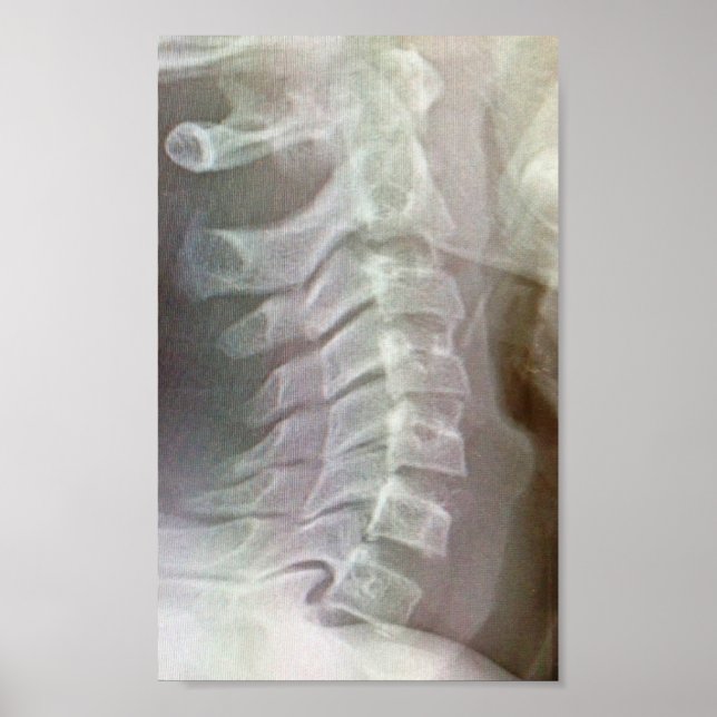 Pôster Torneio da coluna cervical (Frente)