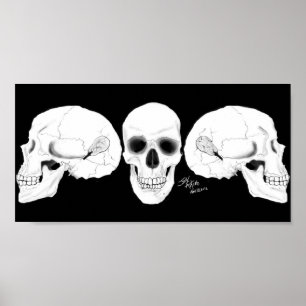 Poster Vê o crânio com o CIs removido