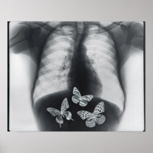 Pôster X-ray of butterflies in the stomach