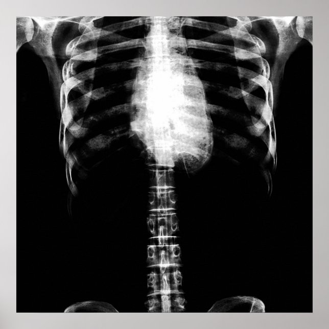 PÔSTER X RAY SKELETON TORSO RIBS - B&W (Frente)
